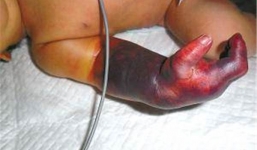 Em bé bị hoại tử cánh tay vì bị mẹ buộc dây cao su